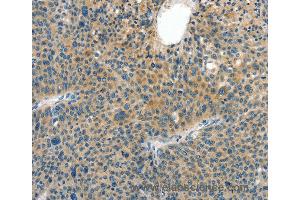 Immunohistochemistry of Human thyroid cancer using CRLF2 Polyclonal Antibody at dilution of 1:60