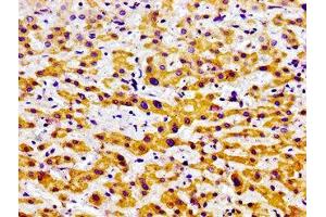 Immunohistochemistry of paraffin-embedded human liver cancer using ABIN7164629 at dilution of 1:100