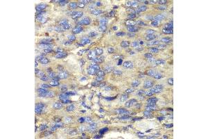 Immunohistochemistry of paraffin-embedded human liver cancer using SDHA antibody at dilution of 1:100 (400x lens). (SDHA antibody)