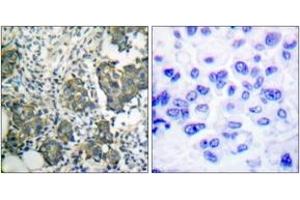 Immunohistochemistry analysis of paraffin-embedded human breast carcinoma tissue, using Keratin 8 (Ab-73) Antibody.