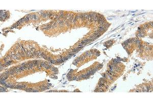 Immunohistochemistry of paraffin-embedded Human colon cancer tissue using MDK Polyclonal Antibody at dilution 1:60 (Midkine antibody)