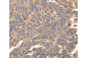 Immunohistochemistry of Human ovarian cancer using IRF1 Polyclonal Antibody at dilution of 1:40 (IRF1 antibody)