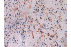 IHC-P analysis of Human Prostate Gland Cancer Tissue, with DAB staining. (Butyrylcholinesterase antibody  (AA 29-150))