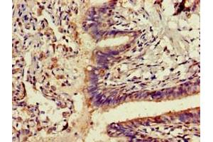 Immunohistochemistry of paraffin-embedded human lung cancer using ABIN7143291 at dilution of 1:100 (ADK antibody  (AA 18-256))