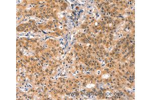 Immunohistochemistry of Human gastric cancer using EIF4G1 Polyclonal Antibody at dilution of 1:30