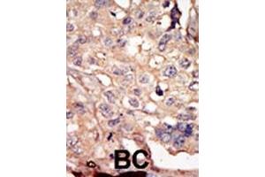 Formalin-fixed and paraffin-embedded human cancer tissue reacted with the primary antibody, which was peroxidase-conjugated to the secondary antibody, followed by AEC staining. (NUAK1 antibody  (N-Term))