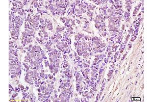 Formalin-fixed and paraffin embedded human lung carcinoma labeled with Anti GTF2B Polyclonal Antibody, Unconjugated (ABIN872694) at 1:200 followed by conjugation to the secondary antibody and DAB staining (GTF2B antibody  (AA 141-250))