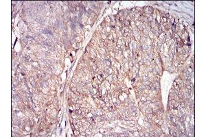 Immunohistochemical analysis of paraffin-embedded ovarian cancer tissues using FTL mouse mAb with DAB staining. (FTL antibody  (AA 1-175))