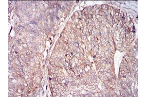 Immunohistochemical analysis of paraffin-embedded ovarian cancer tissues using FTL mouse mAb with DAB staining. (FTL antibody  (full length))