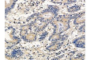 ABIN6260104 and ABIN6278139 at 1/100 staining human colorectal cancer by IHC-P. (ATG4A antibody  (N-Term))
