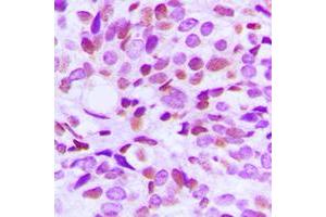 Immunohistochemical analysis of BRAF35 staining in human breast cancer formalin fixed paraffin embedded tissue section. (HMG20B antibody  (N-Term))