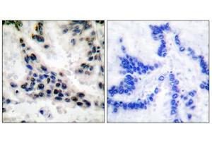 Immunohistochemical analysis of paraffin-embedded human lung carcinoma tissue, using HDAC1 antibody (ABIN5976420). (HDAC1 antibody  (C-Term))