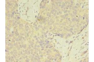 Immunohistochemistry of paraffin-embedded human gastric cancer using ABIN7175049 at dilution of 1:100 (C2ORF69 antibody  (AA 117-269))
