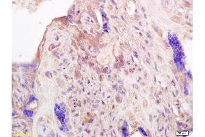 Formalin-fixed and paraffin embedded human placenta labeled with Anti-PRL Polyclonal Antibody, Unconjugated (ABIN669456) at 1:200 followed by conjugation to the secondary antibody and DAB staining. (Prolactin antibody  (AA 165-227))