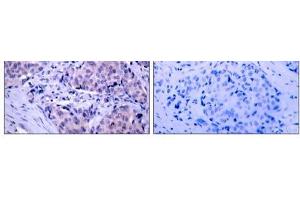Immunohistochemical analysis of paraffin- embedded human breast carcinoma tissue using PDK1 (Ab-241) antibody (E021005). (PDPK1 antibody)