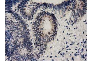 Immunohistochemical staining of paraffin-embedded Adenocarcinoma of Human endometrium tissue using anti-EFNA2 mouse monoclonal antibody. (Ephrin A2 antibody)