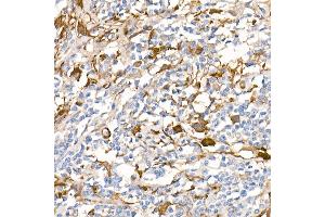 Immunohistochemistry of paraffin-embedded Human Hodgkin lymphoma (positive control antibody staining, clone 55k-2) using Fascin/FSCN1 antibody (ABIN7267142) at dilution of 1:100 (40x lens). (Fascin antibody)
