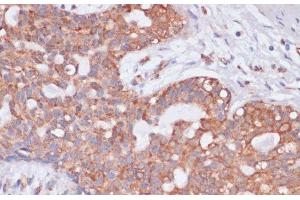 Immunohistochemistry of paraffin-embedded Human breast cancer using KCNH2 Polyclonal Antibody at dilution of 1:100 (40x lens). (KCNH2 antibody)