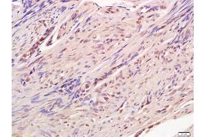 Formalin-fixed and paraffin embedded human endometrium labeled with Anti-CREB-1 Polyclonal Antibody, Unconjugated (ABIN723950) at 1:200 followed by conjugation to the secondary antibody and DAB staining (CREB1 antibody  (AA 101-150))