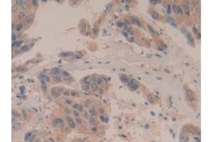 Detection of BAD in Human Breast cancer Tissue using Polyclonal Antibody to Bcl2 Associated Death Promoter (BAD) (BAD antibody  (AA 1-168))