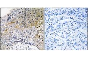 Immunohistochemistry analysis of paraffin-embedded human breast carcinoma tissue, using p130 Cas (Ab-410) Antibody. (BCAR1 antibody  (AA 376-425))