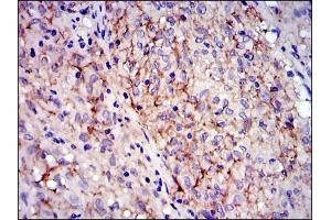 Immunohistochemical analysis of paraffin-embedded gastrointestinal stromal tumor using KIT mouse mAb with DAB staining. (KIT antibody)