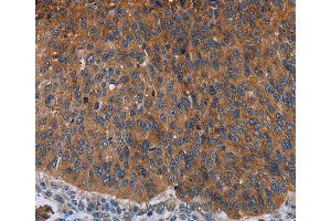Immunohistochemistry of Human lung cancer using JUP Polyclonal Antibody at dilution of 1:50 (JUP antibody)