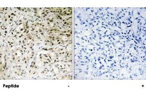 Immunohistochemistry analysis of paraffin-embedded human liver carcinoma tissue using TAF5 polyclonal antibody . (TAF5 antibody)
