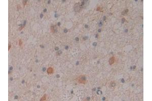 DAB staining on IHC-P; Samples: Human Glioma Tissue (CNTNAP4 antibody  (AA 706-886))