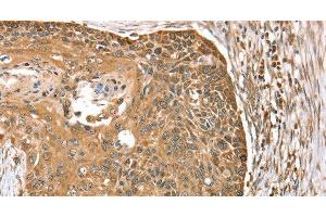 Immunohistochemistry of paraffin-embedded Human esophagus cancer using MORF4L1 Polyclonal Antibody at dilution of 1:35 (MORF4L1 antibody)