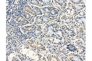 ABIN6257942 and ABIN6275202 at 1/100 staining human pancreatic cancer and adjacent non-tumor tissue by IHC-P.