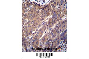 ARL2 Antibody immunohistochemistry analysis in formalin fixed and paraffin embedded human hepatocarcinoma followed by peroxidase conjugation of the secondary antibody and DAB staining. (ARL2 antibody  (C-Term))