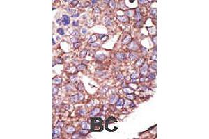 Formalin-fixed and paraffin-embedded human cancer tissue reacted with SYVN1 polyclonal antibody  , which was peroxidase-conjugated to the secondary antibody, followed by DAB staining. (SYVN1 antibody  (C-Term))
