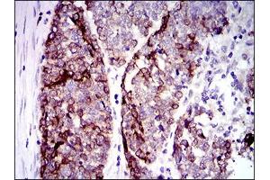 Immunohistochemical analysis of paraffin-embedded esophageal cancer tissues using CK5 mouse mAb with DAB staining. (Cytokeratin 5 antibody  (AA 316-590))