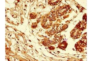 Immunohistochemistry of paraffin-embedded human breast cancer using ABIN7144028 at dilution of 1:100 (Amphiregulin antibody  (AA 107-148))