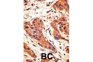 Formalin-fixed and paraffin-embedded human breast cancer tissue reacted with SNAI1 polyclonal antibody  , which was peroxidase-conjugated to the secondary antibody, followed by AEC staining. (SNAIL antibody  (AA 9-39))