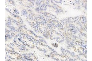ABIN6255629 and ABIN6267394 at 1/100 staining human renal cell carcinoma by IHC-P.