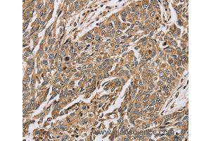 Immunohistochemistry of Human lung cancer using PTGER2 Polyclonal Antibody at dilution of 1:45 (PTGER2 antibody)