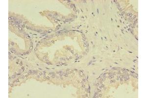Immunohistochemistry of paraffin-embedded human prostate cancer using ABIN7159642 at dilution of 1:100
