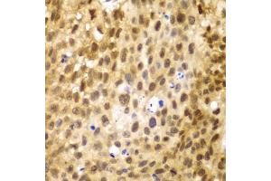 Immunohistochemistry of paraffin-embedded human lung cancer using IRF3 antibody.