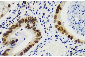Immunohistochemistry of paraffin-embedded Human gastric cancer using RNF2 Polyclonal Antibody at dilution of 1:100 (40x lens). (RNF2 antibody)