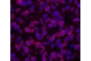 Immunofluorescence analysis of Human lung cancer tissue using Lamin B1 Monoclonal Antibody at dilution of 1:200. (Lamin B1 antibody)