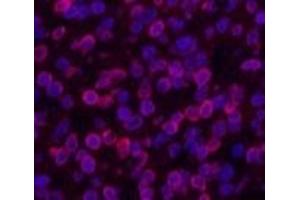 Immunofluorescence analysis of Human lung cancer tissue using Lamin B1 Monoclonal Antibody at dilution of 1:200.