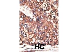 Formalin-fixed and paraffin-embedded human cancer tissue reacted with the primary antibody, which was peroxidase-conjugated to the secondary antibody, followed by DAB staining. (Leptin Receptor antibody  (N-Term))