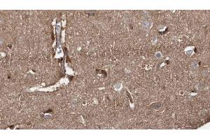 ABIN6279190 at 1/100 staining Human brain cancer tissue by IHC-P. (B4GALT7 antibody)