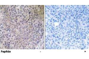 Immunohistochemistry analysis of paraffin-embedded human lung carcinoma tissue using NDUFS7 polyclonal antibody .