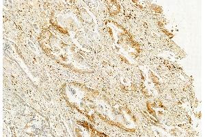 ABIN6262478 and ABIN6272858 at 1/100 staining Human pancreatic cancer by IHC-P.