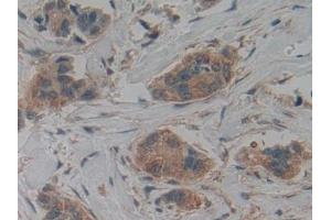Detection of CK9 in Human Breast cancer Tissue using Polyclonal Antibody to Cytokeratin 9 (CK9) (KRT9 antibody  (AA 315-456))