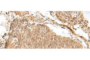 Immunohistochemistry of paraffin-embedded Human esophagus cancer tissue using GEMIN4 Polyclonal Antibody at dilution of 1:30(x200) (GEMIN4 antibody)