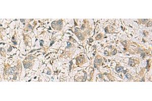 Immunohistochemistry of paraffin-embedded Human liver cancer tissue using CMTM1 Polyclonal Antibody at dilution of 1:40(x200) (CMTM1 antibody)